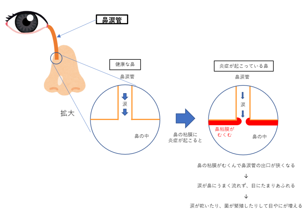 目やにの話 | つま小児科クリニック